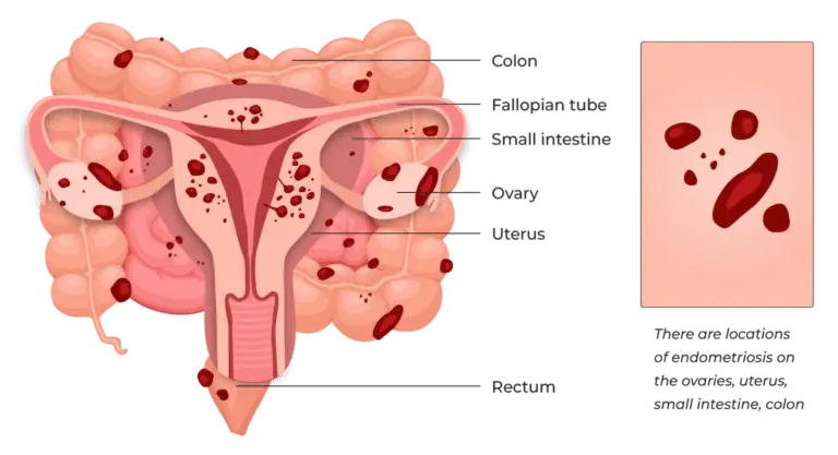 Endometriosis and Fertility