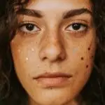 How to Heal Hormonal Acne Naturally